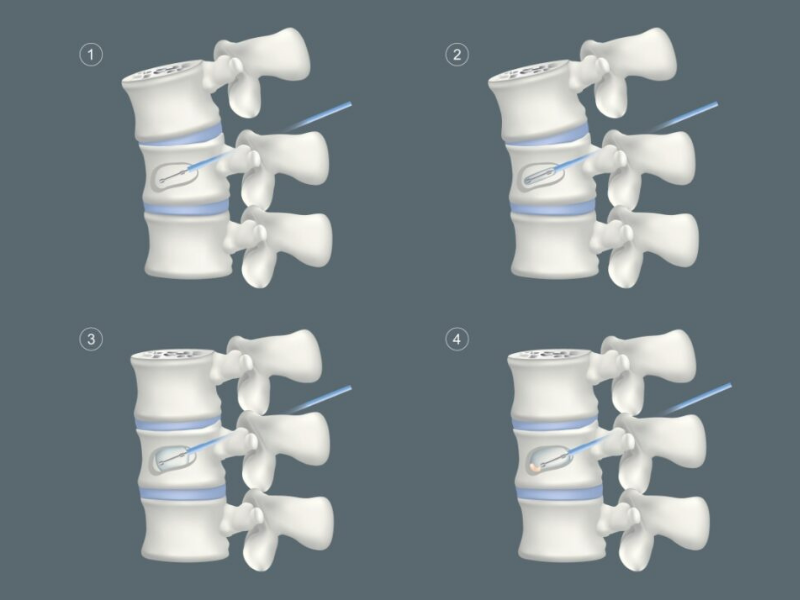 Vertebroplasty